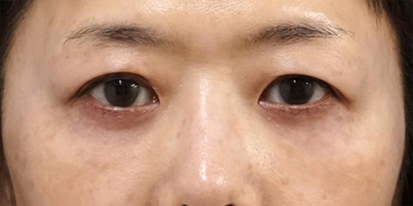 目の下脂肪取り・コンデンス脂肪注入　７ヶ月後のAfterの写真