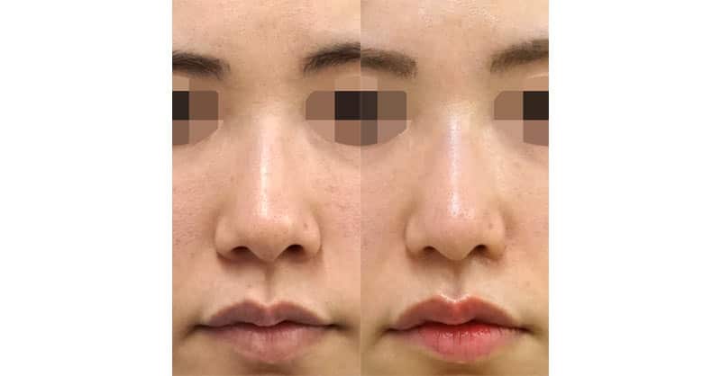 鼻尖縮小、小鼻縮小（内側＋外側）　６ヶ月後変化　サムネイル