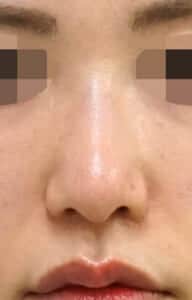 鼻尖縮小、小鼻縮小（内側＋外側）　６ヶ月後　正面