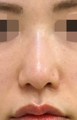 鼻尖縮小・小鼻縮小（内側＋外側）　６ヶ月後　正面のAfterの写真