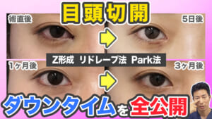 【目頭切開】ダウンタイムの経過を術式別(Z形成・リドレープ法・Park法)で解説