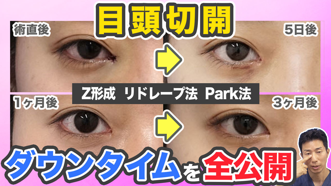 【目頭切開】施術ごとにダウンタイムの違いはある？各施術の症例写真の経過をご紹介します