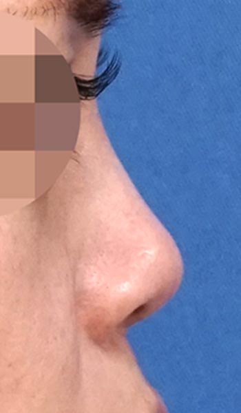 鼻尖縮小・軟骨移植・ストラット　１ヶ月後　右側面のBefore写真