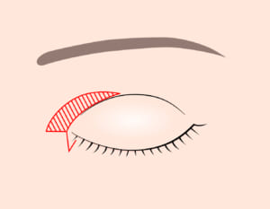 目頭切開Z　閉眼