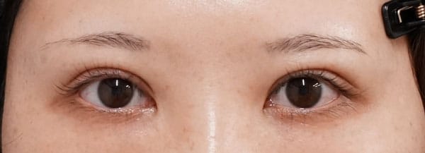 二重全切開＋挙筋前転術（眼瞼下垂）　３ヶ月後