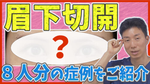 眉下切開をされた8人の方の症例を写真付きで解説