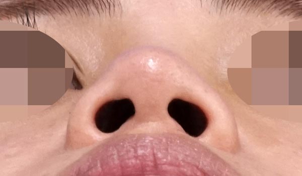 鼻尖縮小・軟骨移植・ストラット　１ヶ月後　下からのBefore写真