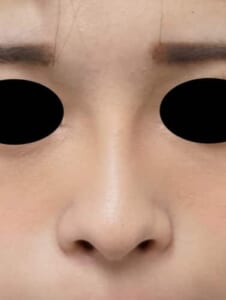症例３　術後