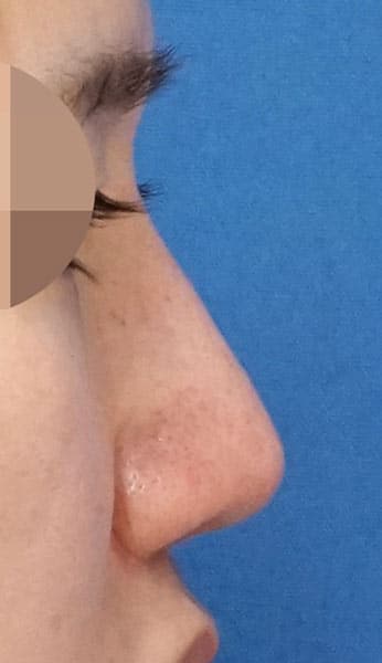 鼻尖縮小(３D法)+軟骨移植+ストラット、鼻柱基部下降、鼻翼縮小(内・外側法)、プロテーゼ　６ヶ月後　右側面