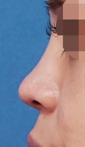 鼻尖縮小・軟骨移植・ストラット　１ヶ月後　左側面のAfterの写真