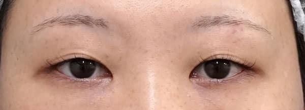 二重全切開＋挙筋前転術（眼瞼下垂）　手術前