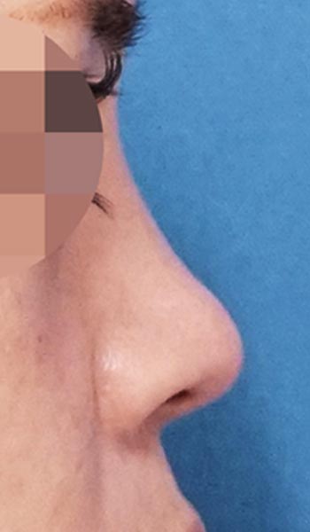 鼻尖縮小・軟骨移植・ストラット　１ヶ月後　右側面のAfterの写真