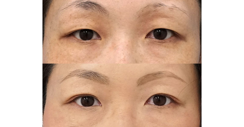 くぼみ目のたるみのある方に、眉下切開出なく二重埋没法をおこなった症例｜２点連結裏止め（スマートバランス）　手術直後～３ヶ月後