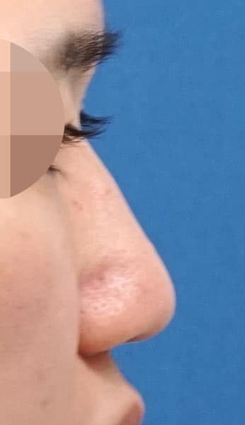 鼻尖縮小(３D法)+軟骨移植+ストラット、鼻柱基部下降、鼻翼縮小(内・外側法)、プロテーゼ　手術前　右側面