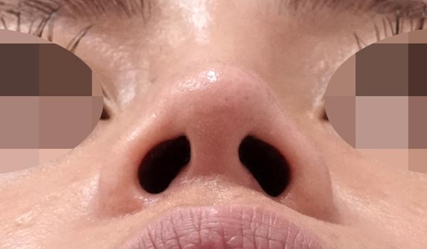 鼻尖縮小・軟骨移植・ストラット　１ヶ月後　下からのAfterの写真