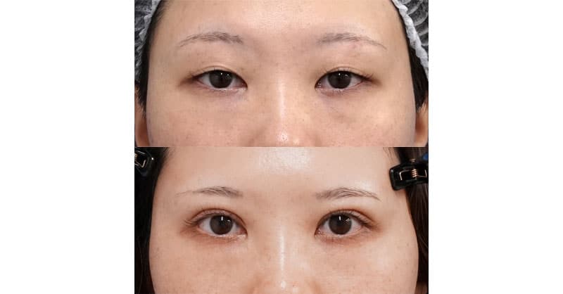 切って眼瞼下垂で目元パッチリ｜二重全切開・挙筋前転（眼瞼下垂）・睫毛側たるみ取り　３ヶ月後