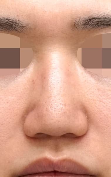 鼻尖縮小(３D法)+軟骨移植+ストラット、鼻柱基部下降、鼻翼縮小(内・外側法)、プロテーゼ　手術前　正面
