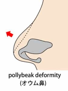 pollybeak deformity(オウム鼻)