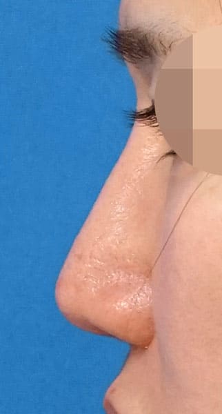 鼻尖縮小(３D法)+軟骨移植+ストラット、鼻柱基部下降、鼻翼縮小(内・外側法)、プロテーゼ　６ヶ月後　左側面