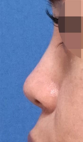 鼻尖縮小・軟骨移植・ストラット　１ヶ月後　左側面のBefore写真