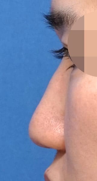 鼻尖縮小(３D法)+軟骨移植+ストラット、鼻柱基部下降、鼻翼縮小(内・外側法)、プロテーゼ　手術前　左側面