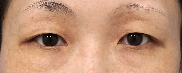 二重埋没法（２点連結裏止め、スマートバランス）　手術前