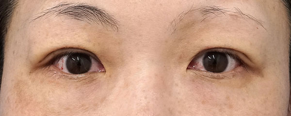 二重埋没法（２点連結裏止め、スマートバランス）　手術直後