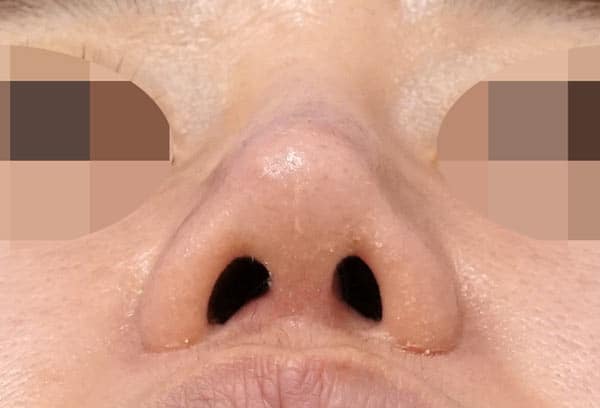 鼻尖縮小(３D法)+軟骨移植+ストラット、鼻柱基部下降、鼻翼縮小(内・外側法)、プロテーゼ　６ヶ月後　下から