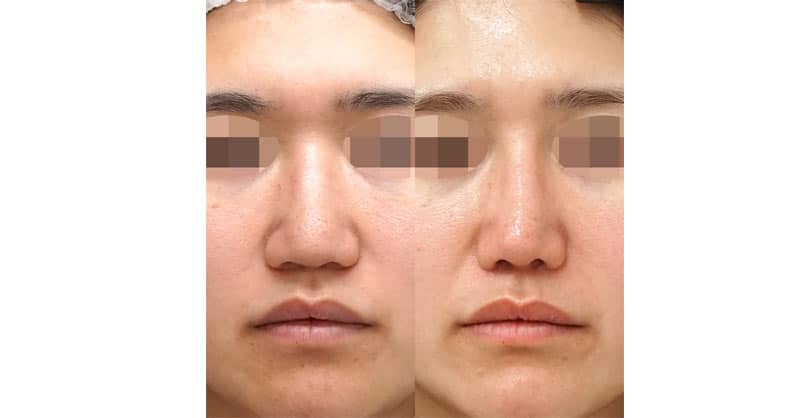 鼻フルで忘れ鼻｜鼻尖縮小３D法・ストラット・軟骨移植・鼻柱基部下降・小鼻縮小（内側＋外側）・鼻プロテーゼ　６ヶ月後
