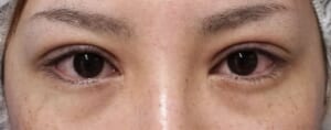 手術直後