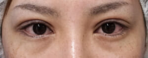 手術直後