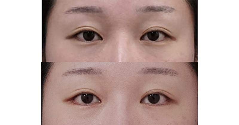 タレ目尻切開で目を自然な感じで大きく、優しく｜下眼瞼下制（皮膚切開）・目尻切開　１ヶ月後