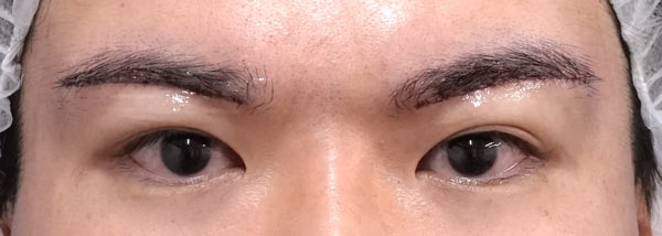 眉下切開　手術直後