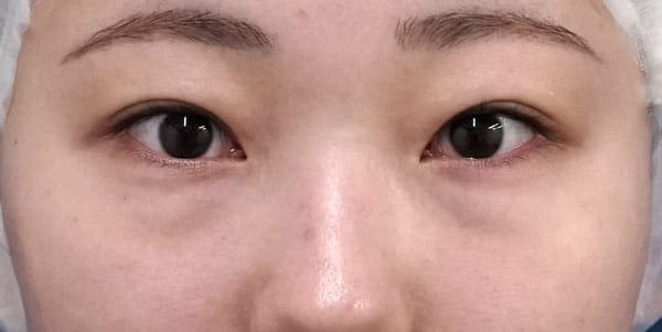 目の下脂肪取り・脂肪注入（目の下）　半年後のBefore写真