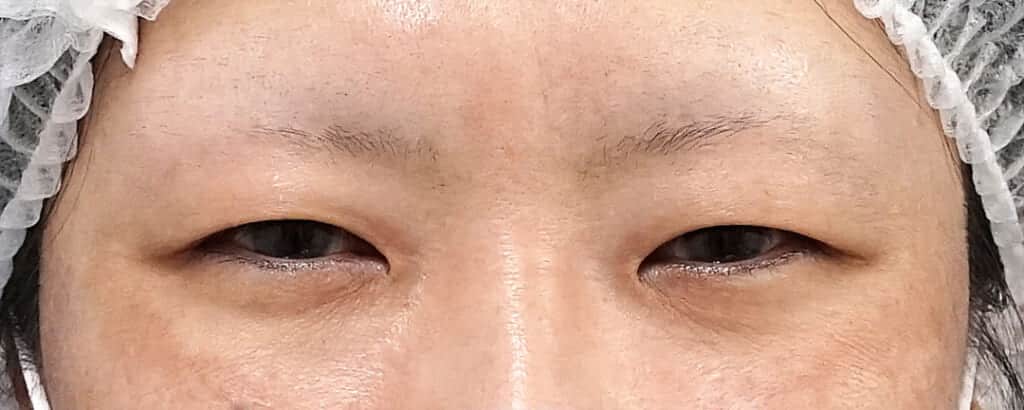 眉下切開、二重埋没法（もとびアイゴールド）しゅ術前