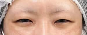眉下切開、二重埋没法（もとびアイゴールド）しゅ術前