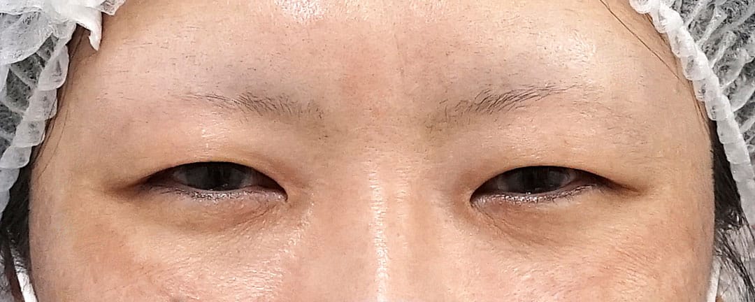 眉下切開８か月後、二重埋没法（もとびアイゴールド）７ヶ月後のBefore写真