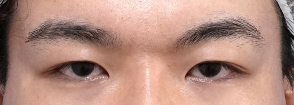 眉下切開　手術前