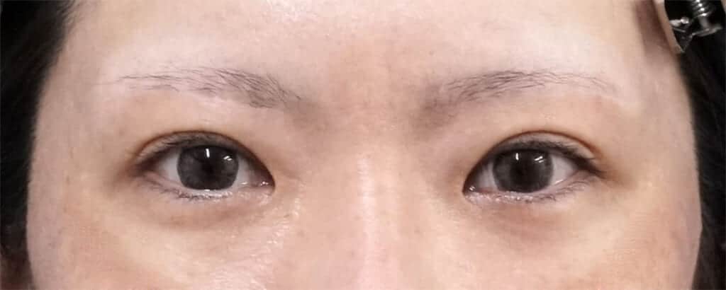 眉下切開８か月後、二重埋没法（もとびアイゴールド）７ヶ月後