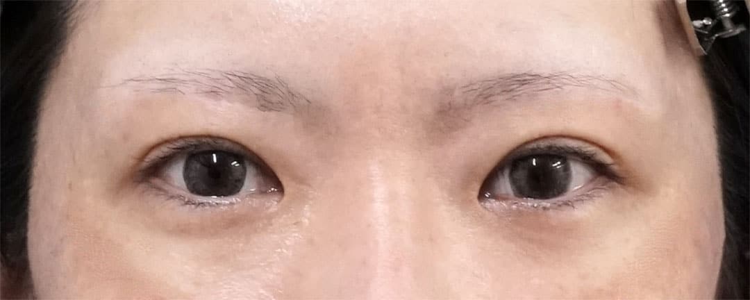 眉下切開８か月後、二重埋没法（もとびアイゴールド）７ヶ月後のAfterの写真
