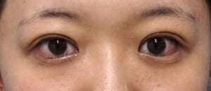 症例2 手術直後開眼