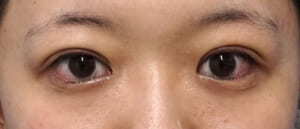 症例２　手術直後開眼