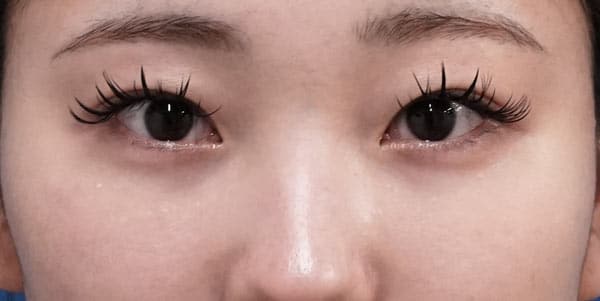 目の下脂肪取り・脂肪注入（目の下）　半年後のAfterの写真