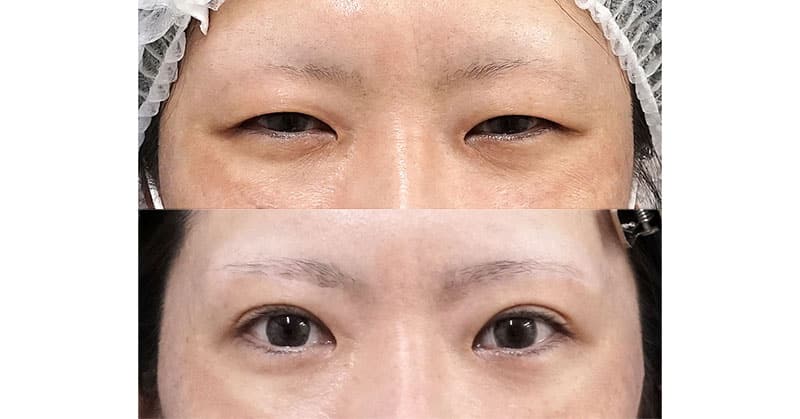 眉下切開８か月後、二重埋没法（もとびアイゴールド）７ヶ月後