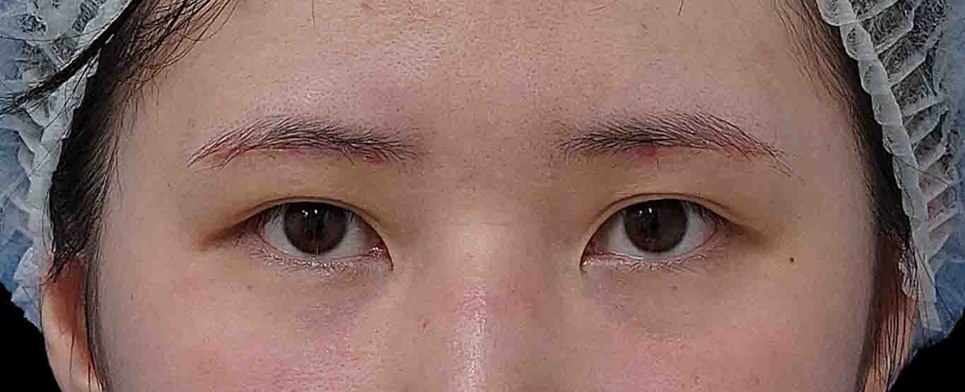 眉下切開 術後3か月のAfterの写真