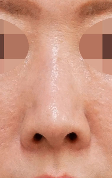 鼻尖縮小＋軟骨移植＋ストラット、鼻孔縁下降　３ヶ月後 　正面のAfterの写真