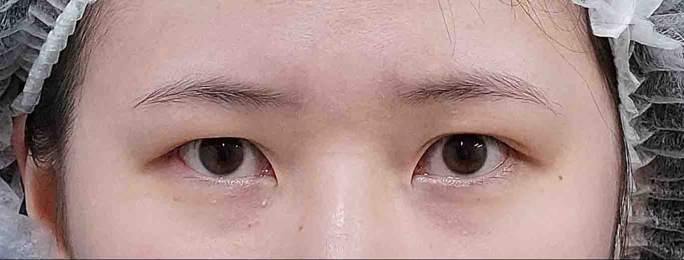 眉下切開 術後6か月、二重埋没（もとびアイゴールド） 術後3か月のBefore写真