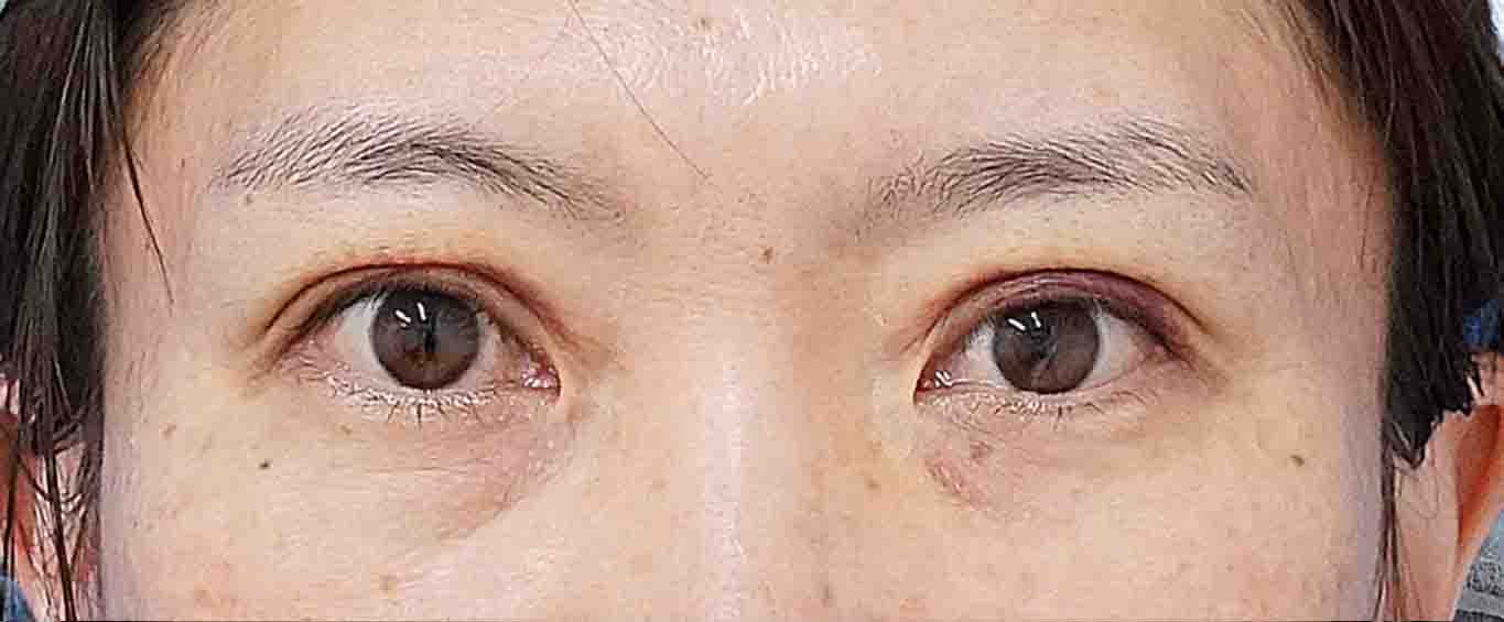 二重埋没法（２点連結表止め、もとびアイライト）　１週間後のAfterの写真