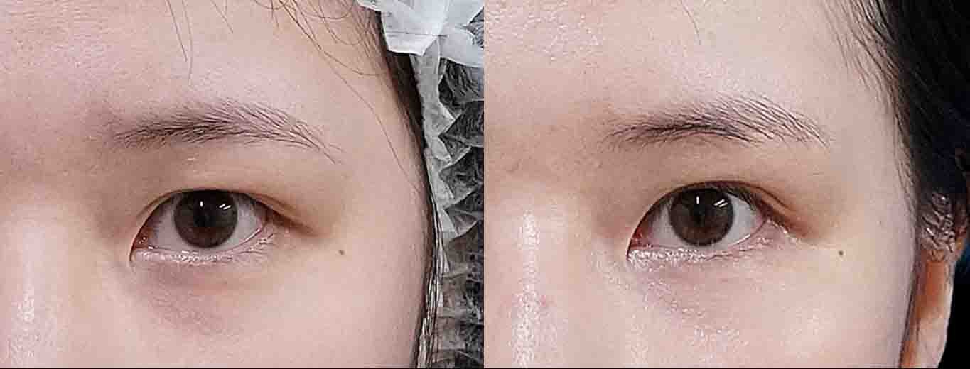 眉下切開＋二重埋没 アイキャッチ