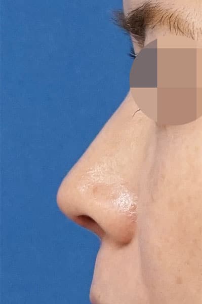 鼻尖縮小＋軟骨移植＋ストラット　１ヶ月後　左側面のAfterの写真